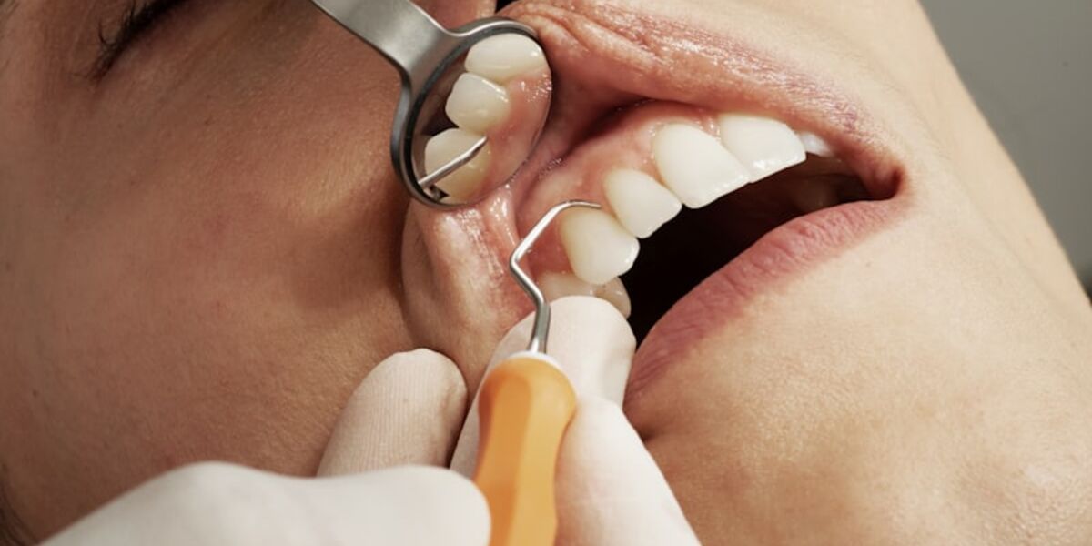 Dental Implants: Costs, Types, and What to Expect in 2026