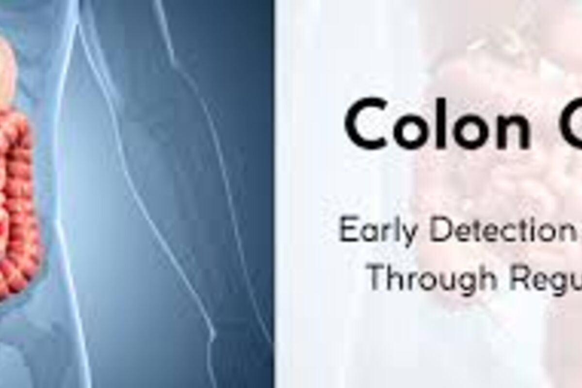 Early Signs of Colon Cancer: Common Symptoms and Screening Information
