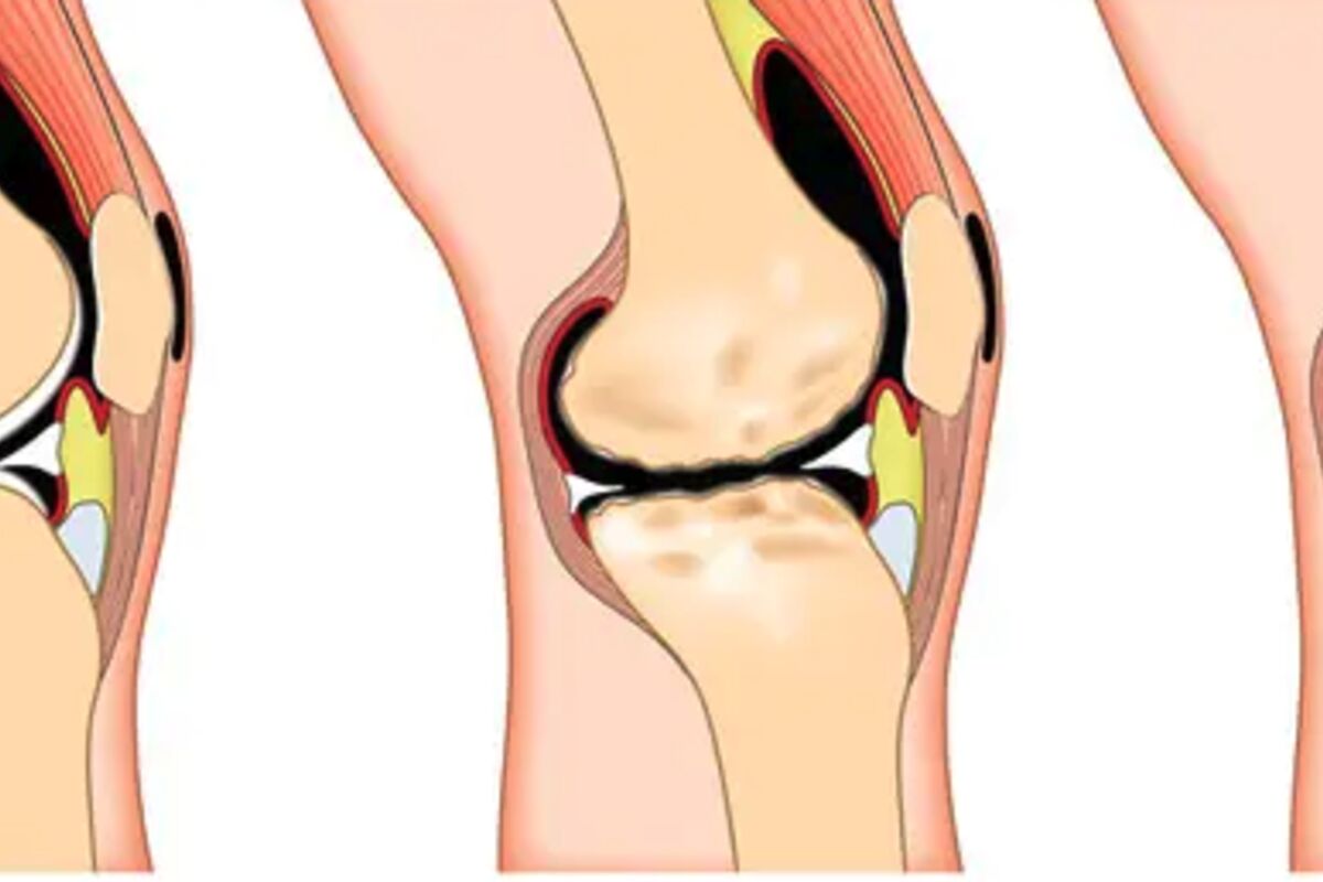 knee pain? Try These Tips To Relieve